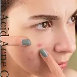 acne cream azelaic acid