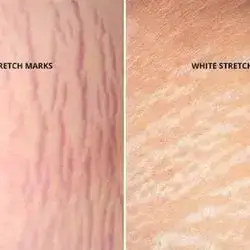 Stretch Marks Repairing Lotion