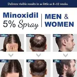 Minoxidil Spray