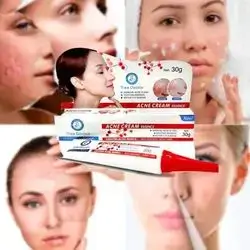 cream for acne
