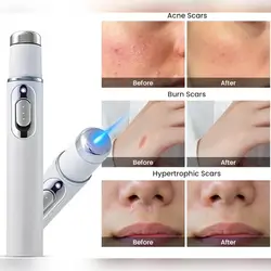 Bule Light Acne Treatment Electronic Face Skin Removal