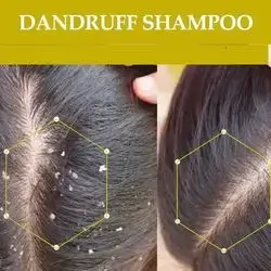 anti dandruff shampoo ketoconazol anti fungal